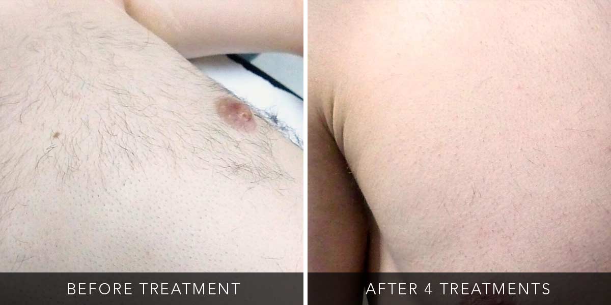 before-after-02